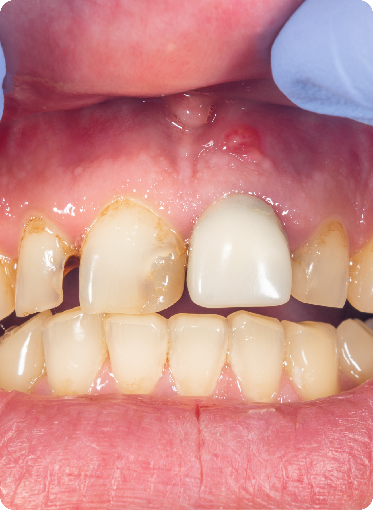 Root canal on a front tooth