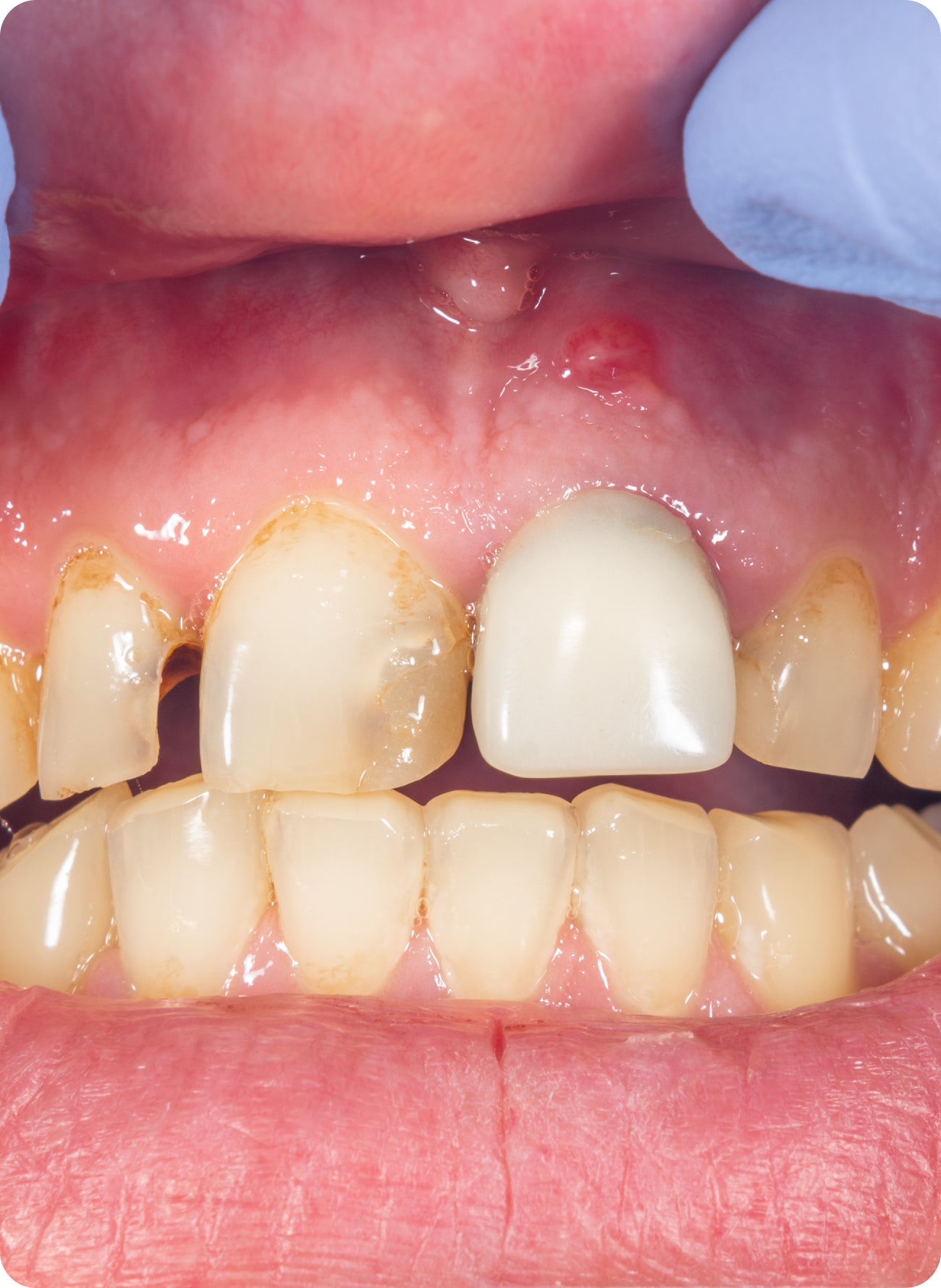 Root canal on a front tooth | Aspen Dental