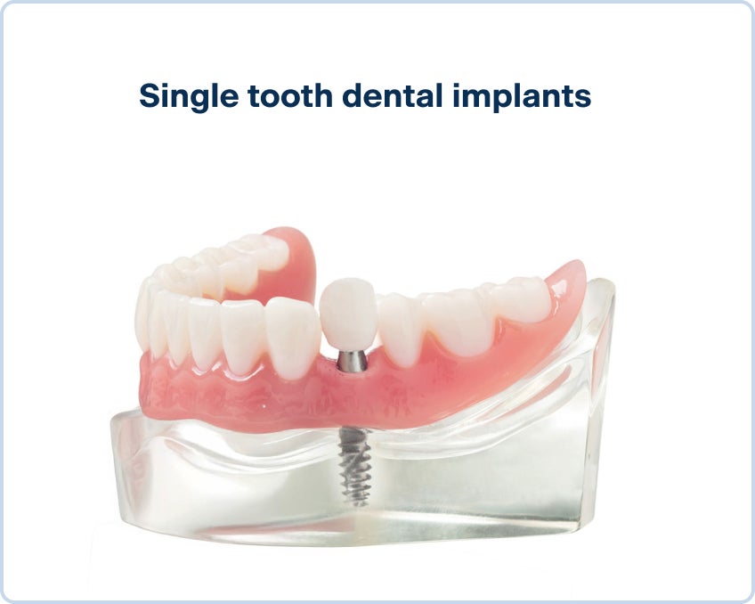 An image of a lower arch teeth model with a single tooth dental implant anchored by the titanium implant screw.