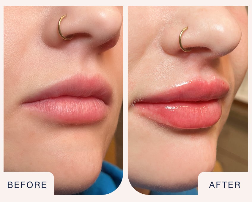 Lip filler before and after results showing enhanced volume, smooth definition, and hydrated finish at Chapter.