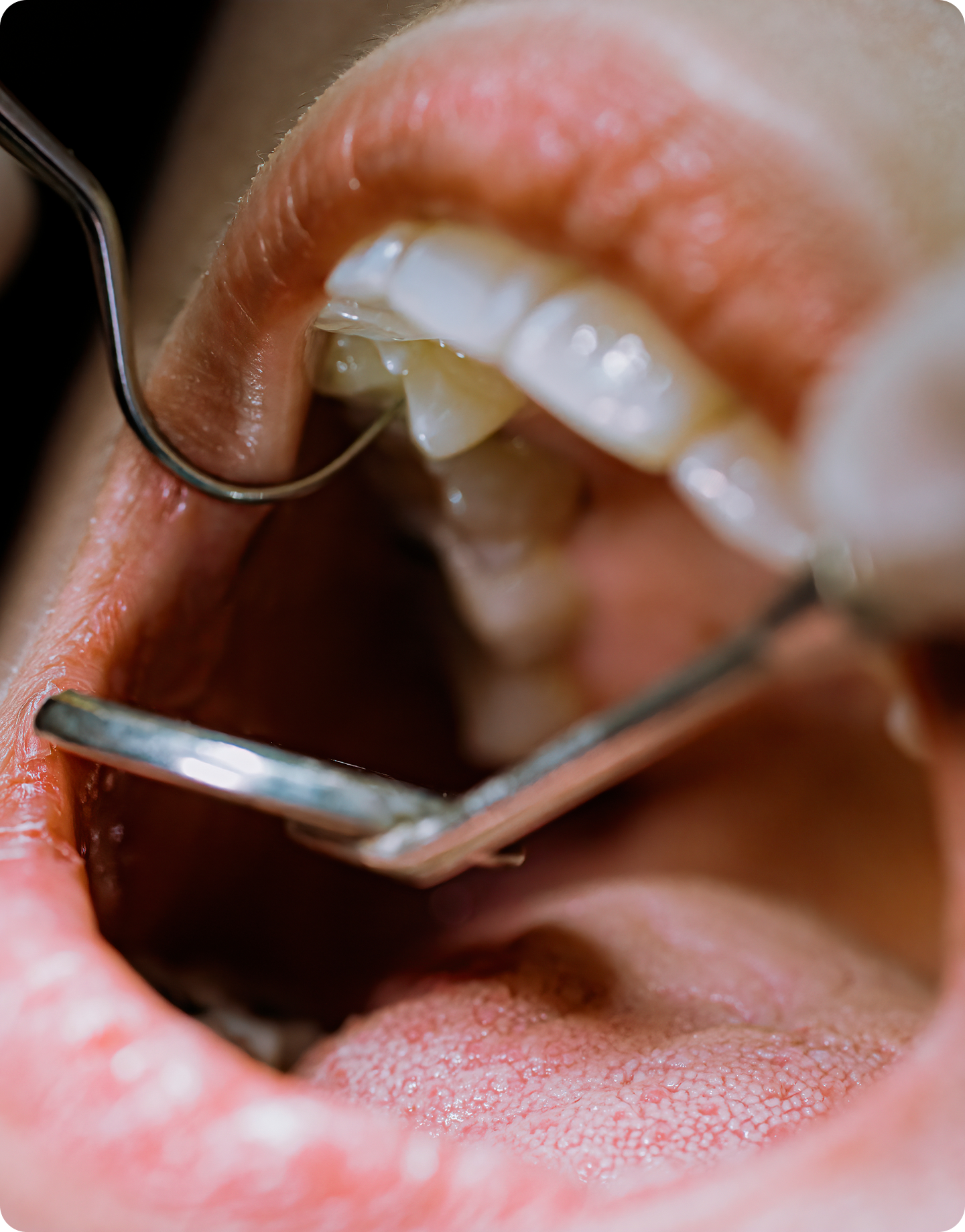 Close-up of an open mouth during a dental exam with a dental mirror and probe.
