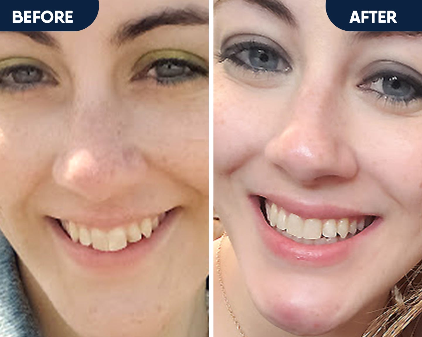 Side by side before and after images, showing a whiter, straighter smile