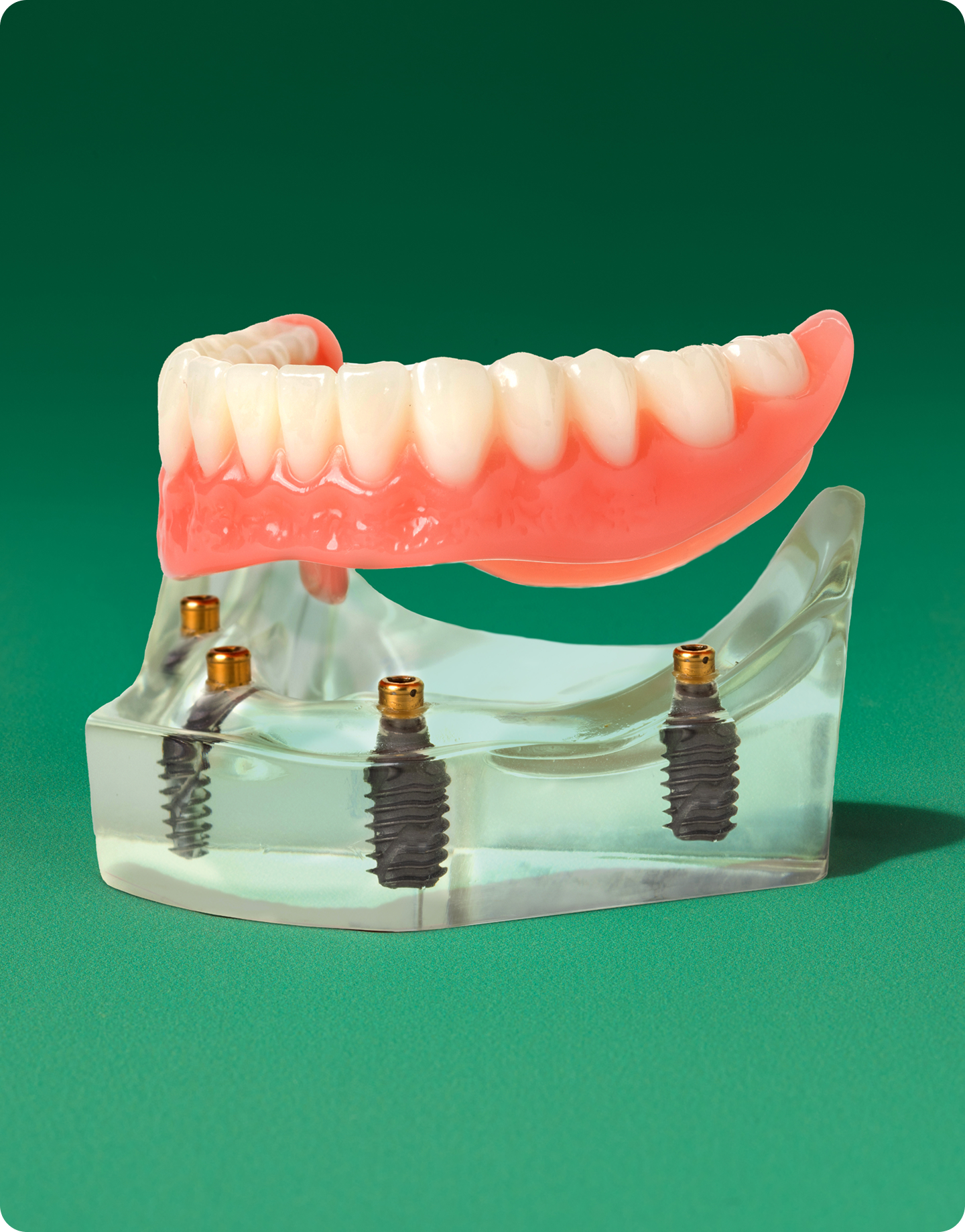 All-on-4® and fixed full arch dental implants