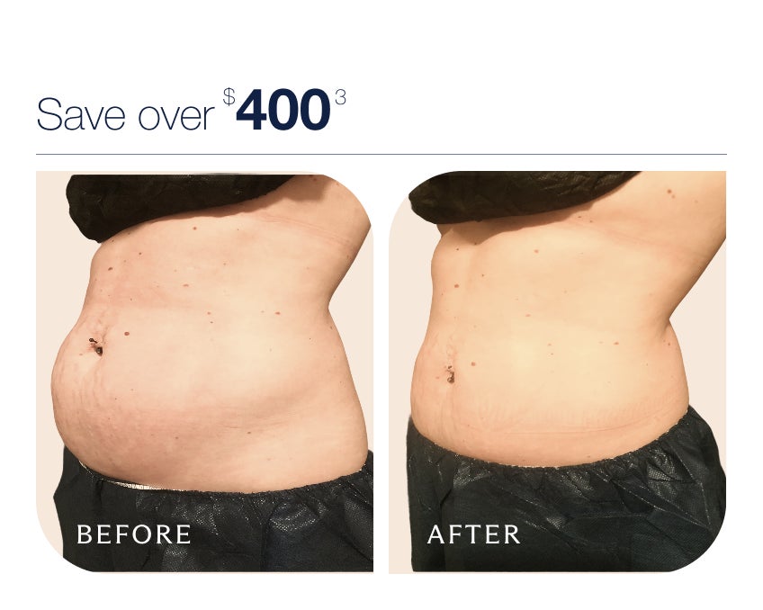 Before and after photos showing abdominal fat reduction from CoolSculpting treatment, with text placed above which reads "Save over $400*"