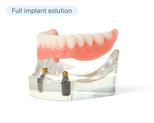A dental model showing a full set of upper teeth implant dentures, labeled "Full implant solution"