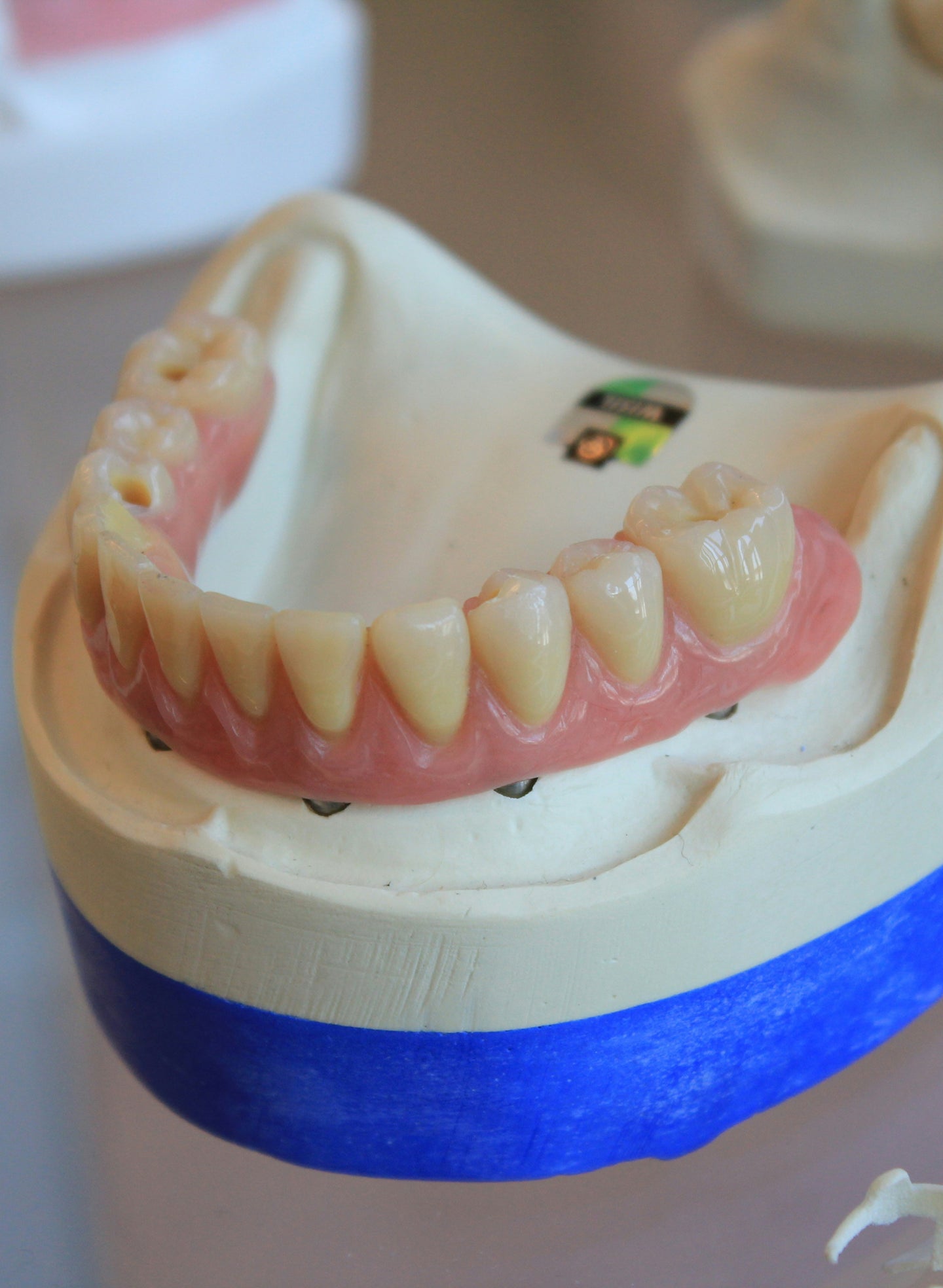 Denture adhesive: when it helps, when it’s a red flag, and what to do next