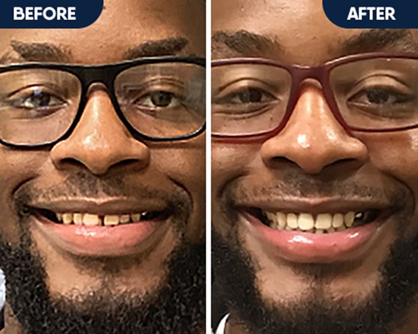 Before and after smile results of a man showing improved teeth alignment with clear aligner treatment from Motto