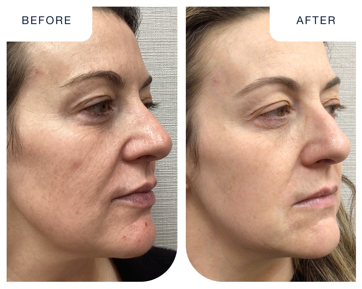 Before and after results of CO2 fractional laser resurfacing at Chapter, showing smoother skin, reduced wrinkles, and improved texture.