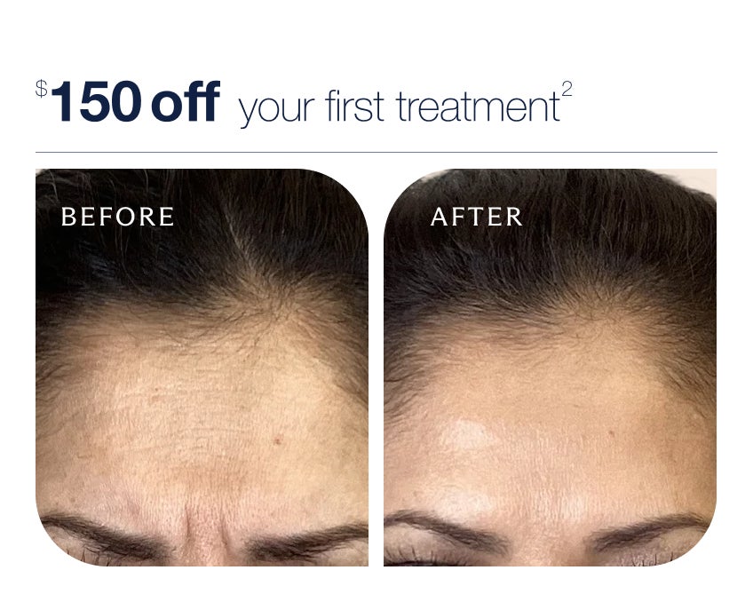 Before and after images showcasing forehead wrinkle reduction from Botox treatment, with text above which reads "$150 off your first treatment"