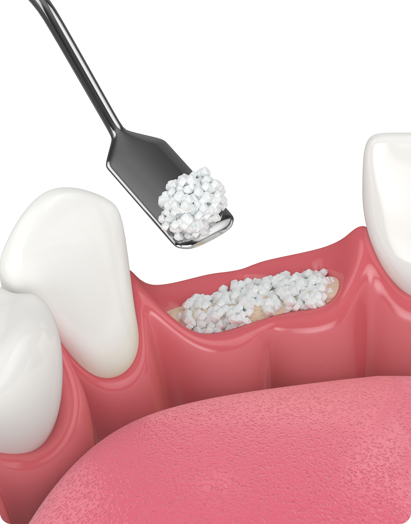 Bone graft material being placed in a dental socket