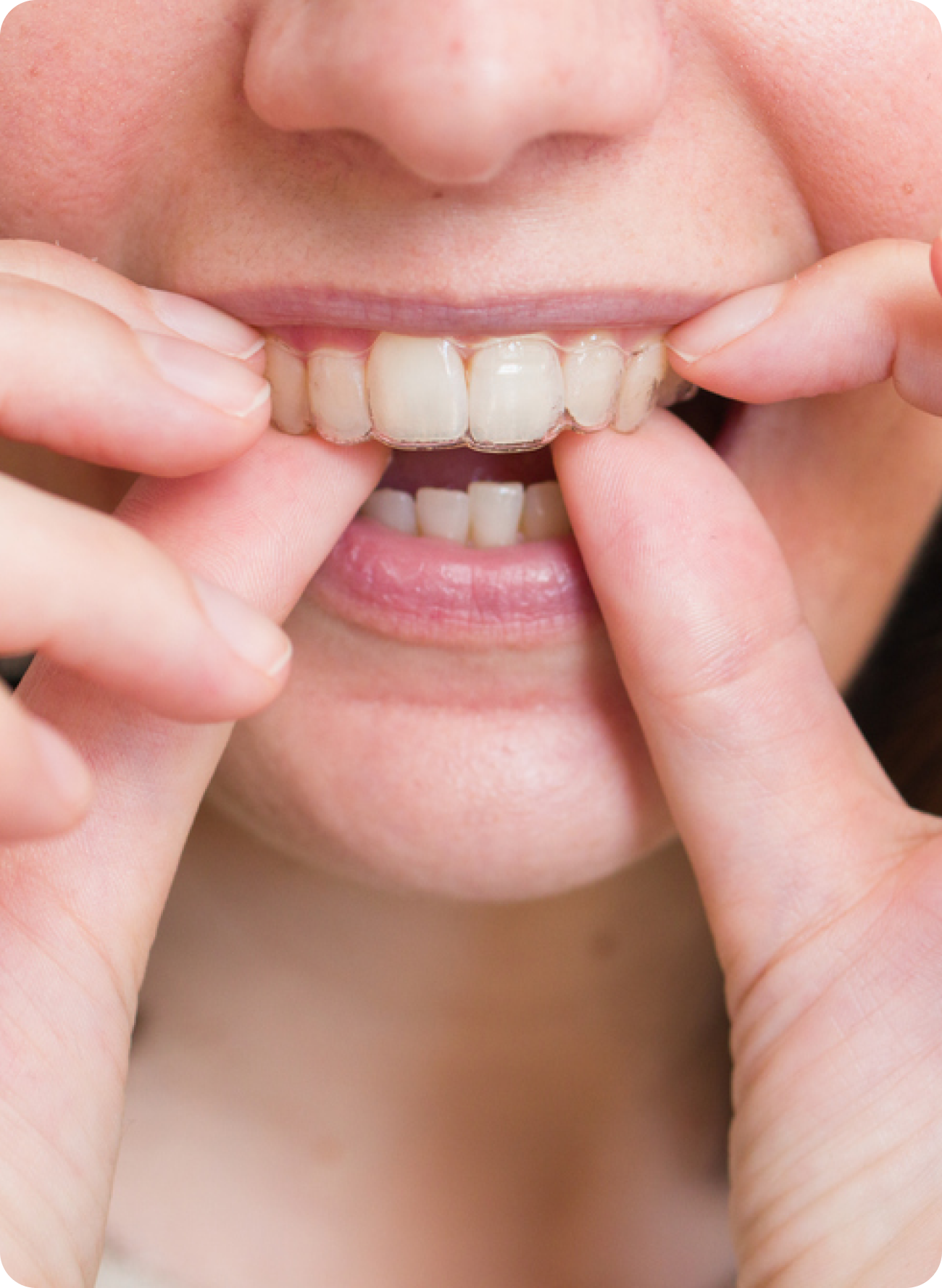 What should I do if my permanent retainer broke?