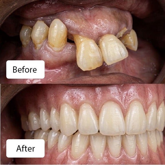 (top) Jacqueline W. before her full mouth extraction and Upper/Lower denture, at Aspen Dental in Pembroke Pines, FL. (bottom) Jacqueline W. with a fresh new smile after her full mouth extraction and upper/lower denture input at Aspen Dental in Pembroke Pines, FL.