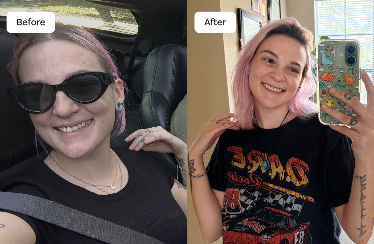 Before and after image of patient after recieving care at Aspen Dental