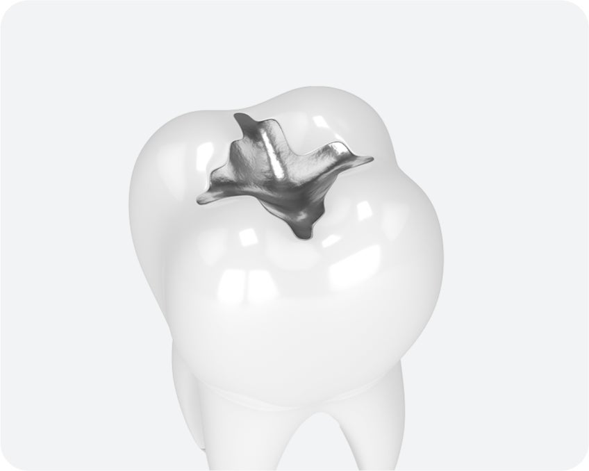A 3D illustration of a white molar tooth featuring a silver-colored metal amalgam filling on the chewing surface.