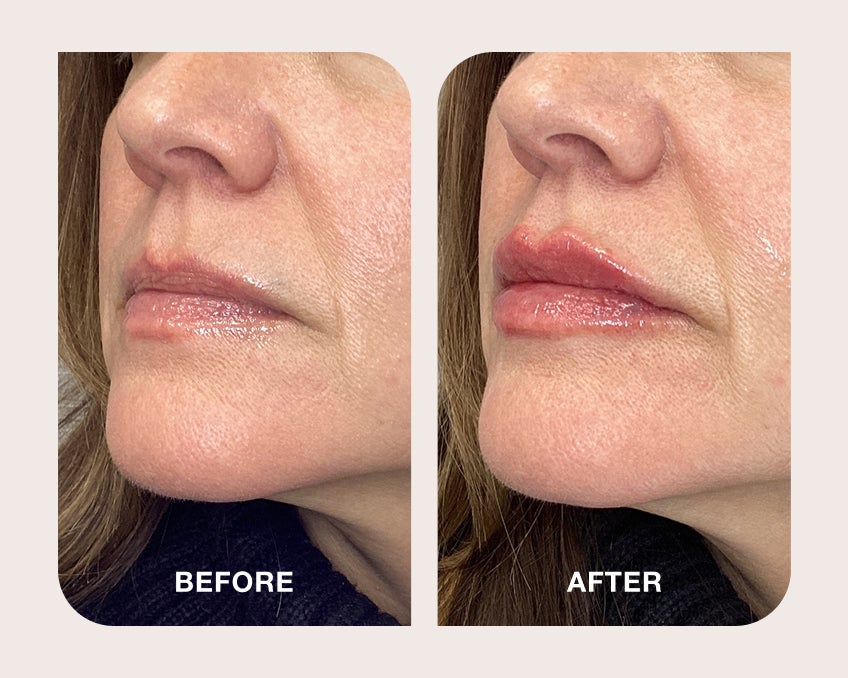 Before and after lip enhancement