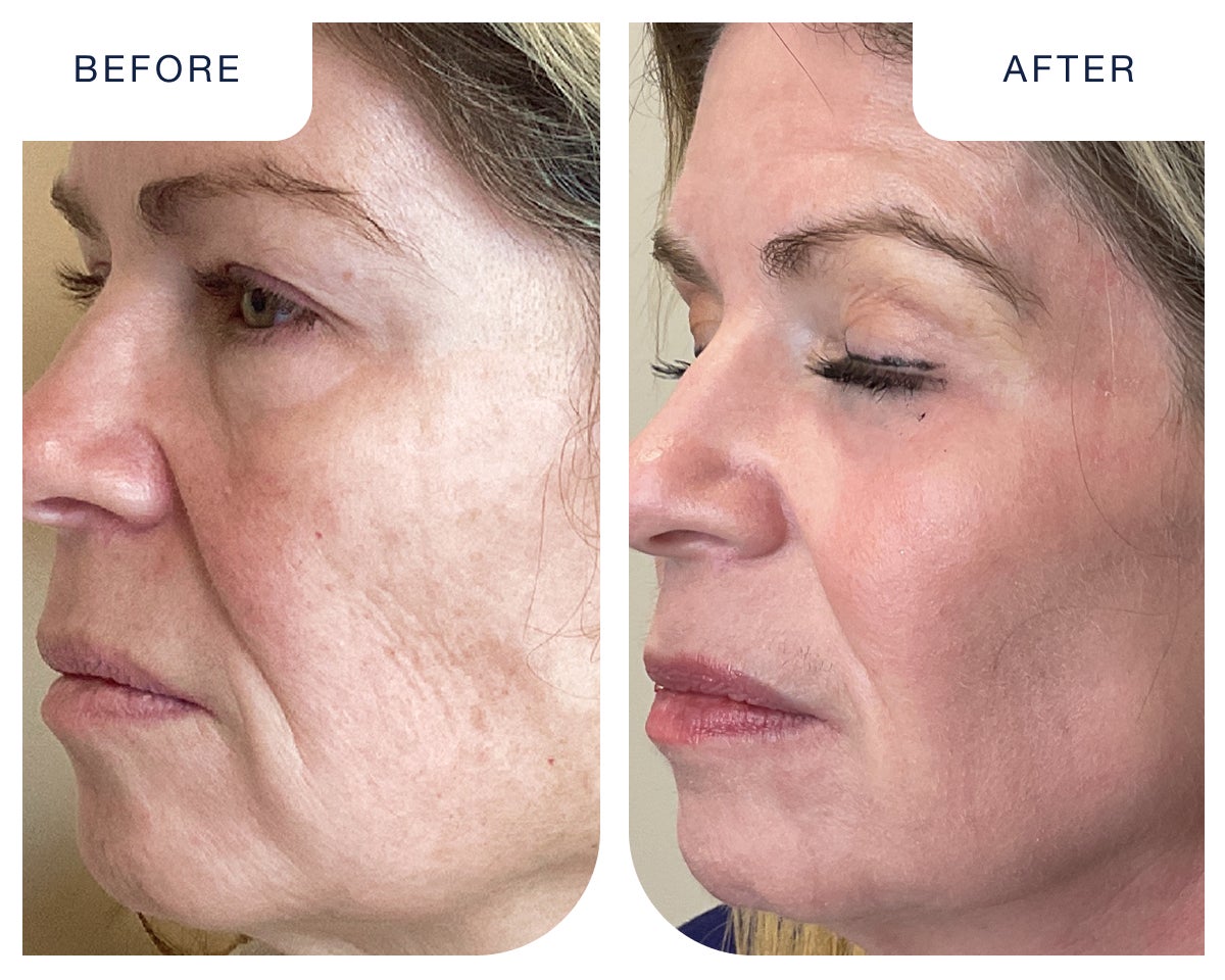 Before and after results of CO2 fractional laser resurfacing at Chapter, showing smoother skin, reduced wrinkles, and improved texture.