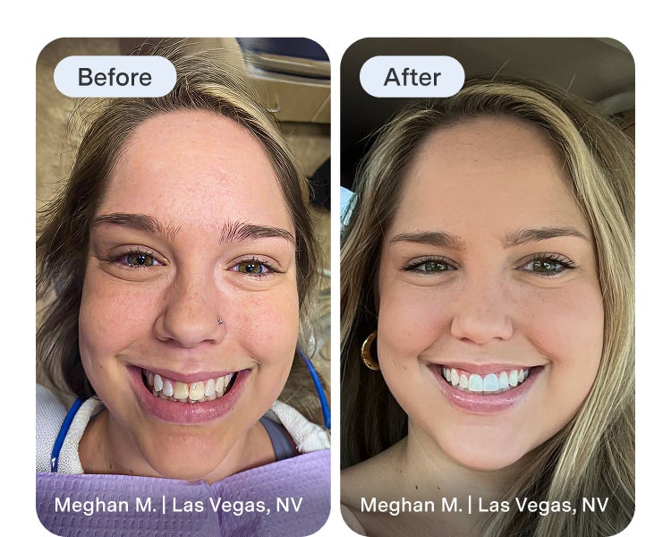 Side-by-side before and after photos of a smiling woman showing a bright, even smile transformation after receiving dental veneers.