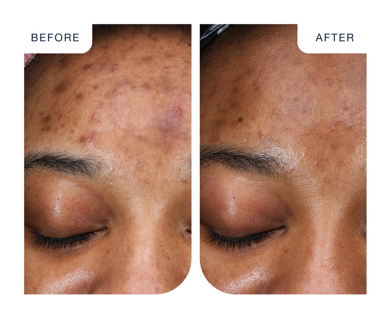 Before and after results of a VI Peel treatment at Chapter, showing clearer skin with reduced blemishes and smoother texture.