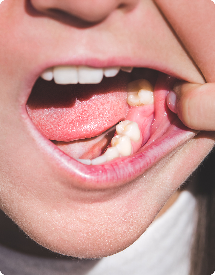 Tooth replacement for missing teeth