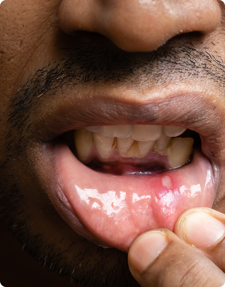 Canker Sore: Causes and Treatment
