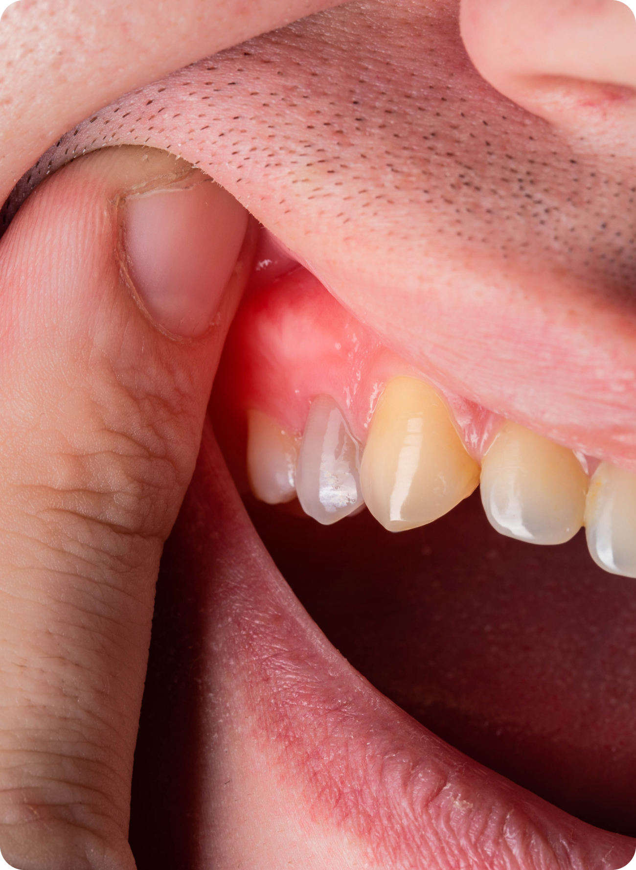 Emergency gum infection: symptoms, risks and when to act fast