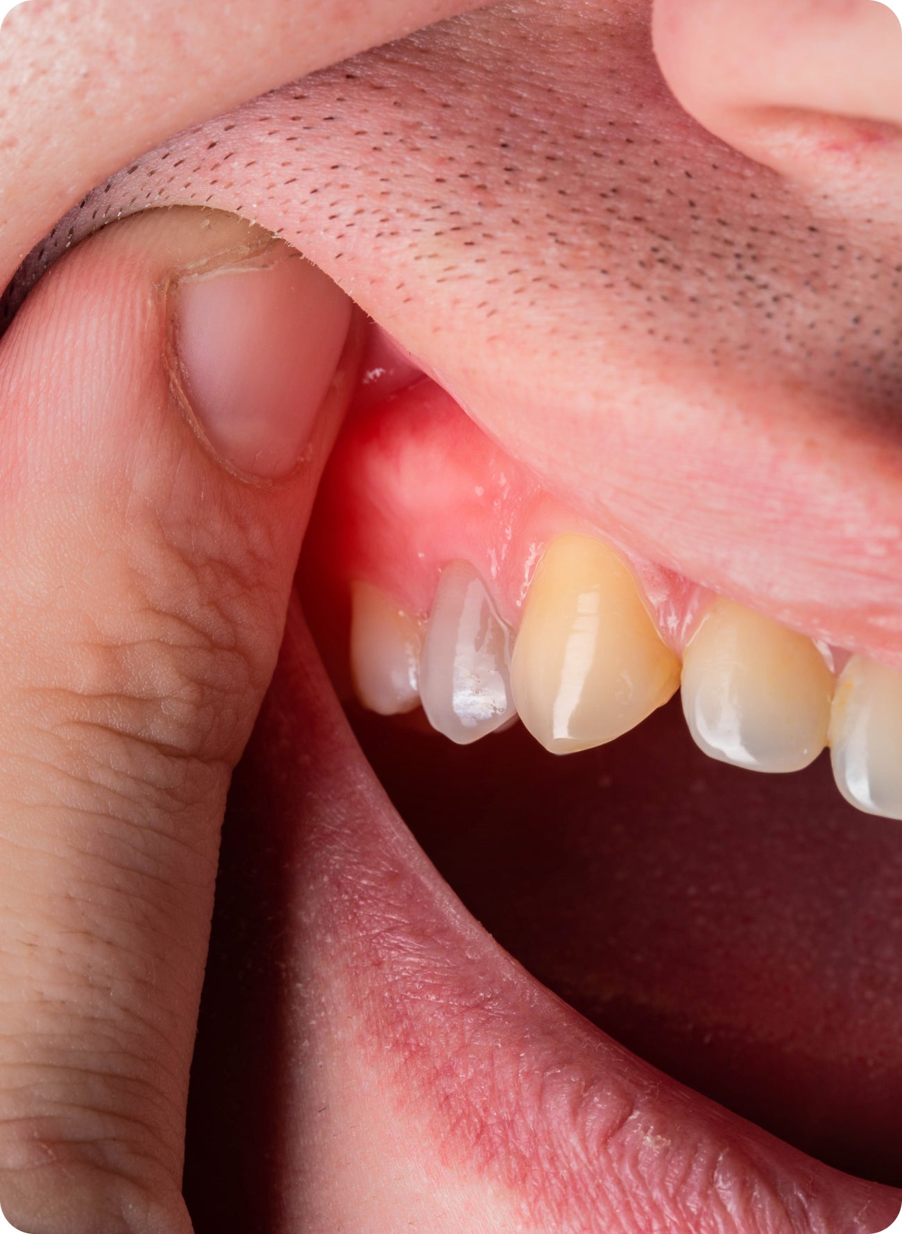 Emergency gum infection: symptoms, risks and when to act fast