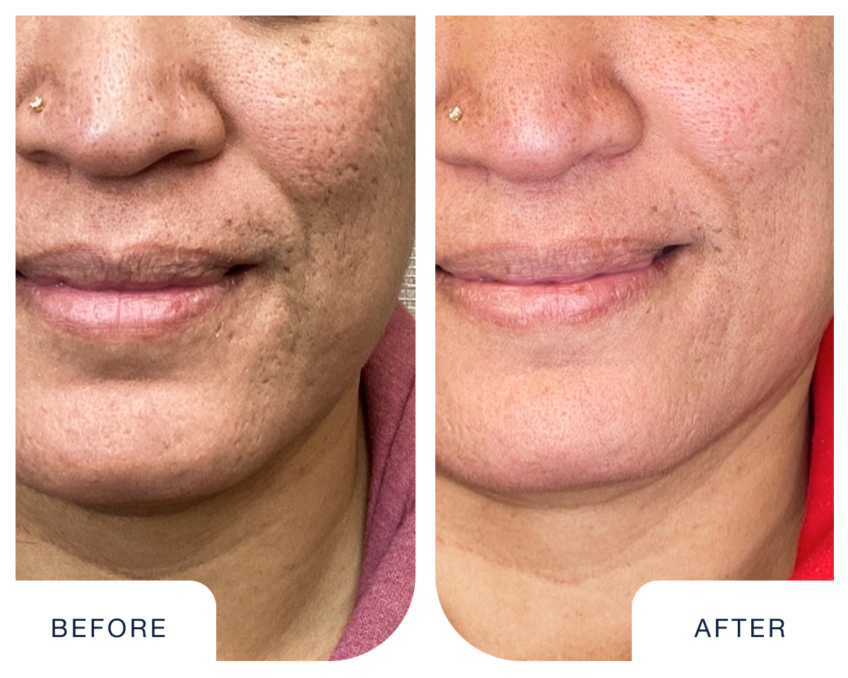 Before and after results of CO2 fractional laser resurfacing at Chapter, showing smoother skin, reduced wrinkles, and improved texture.