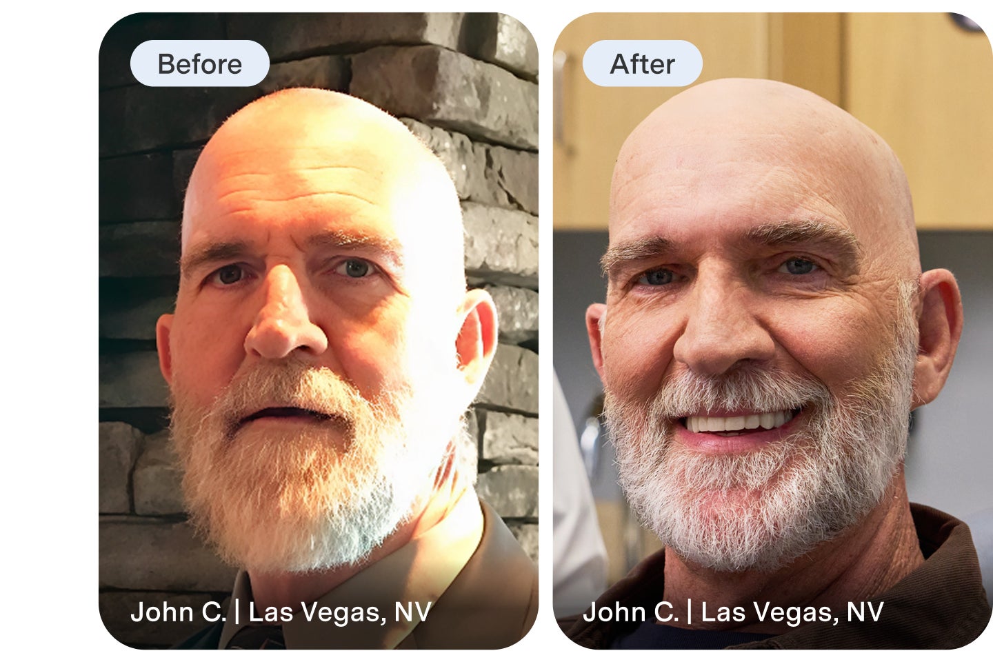 An Aspen Dental implant dentures patient highlights their before image and reveals their new smile after treatment.