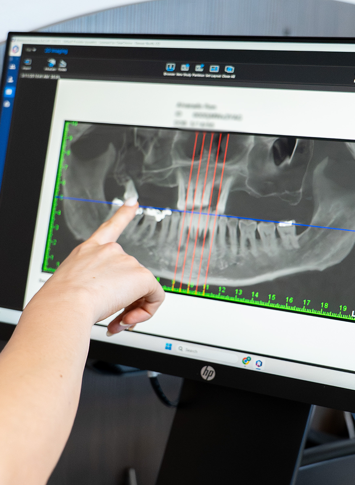 Do I need a bone graft? How bone loss might impact your dental implant treatment plan