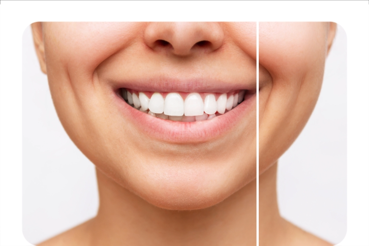 Close-up of a smiling mouth showing a before-and-after comparison of teeth whitening results, with visibly brighter teeth on one side.