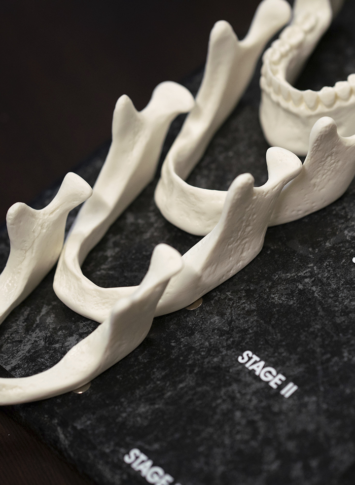 Bone graft failure: Signs, causes and what happens next