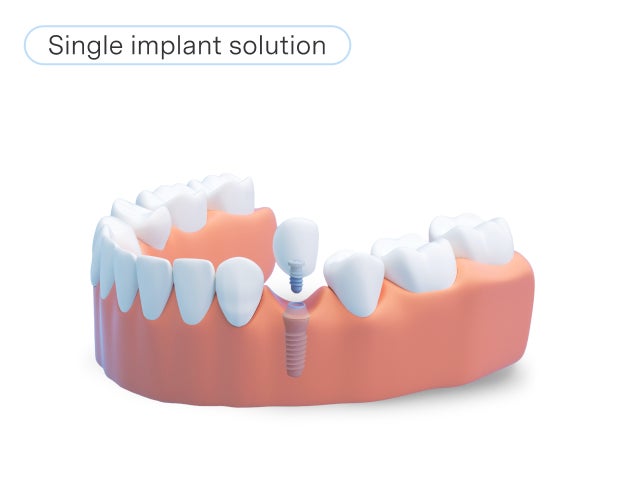 A dental model showing a single tooth implant with one artificial tooth mounted on a screw, labeled "Partial implant solution"