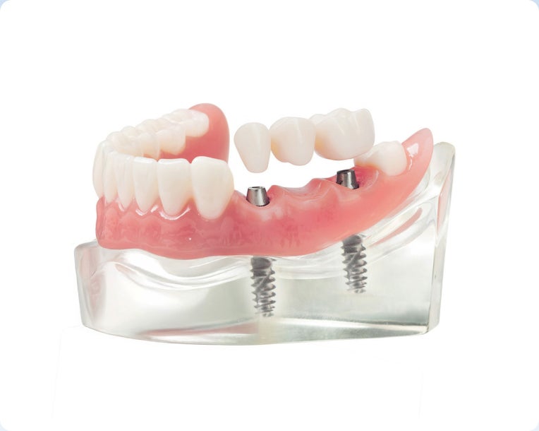A lower arch teeth model with an implant-supported bridge anchored with two implants.
