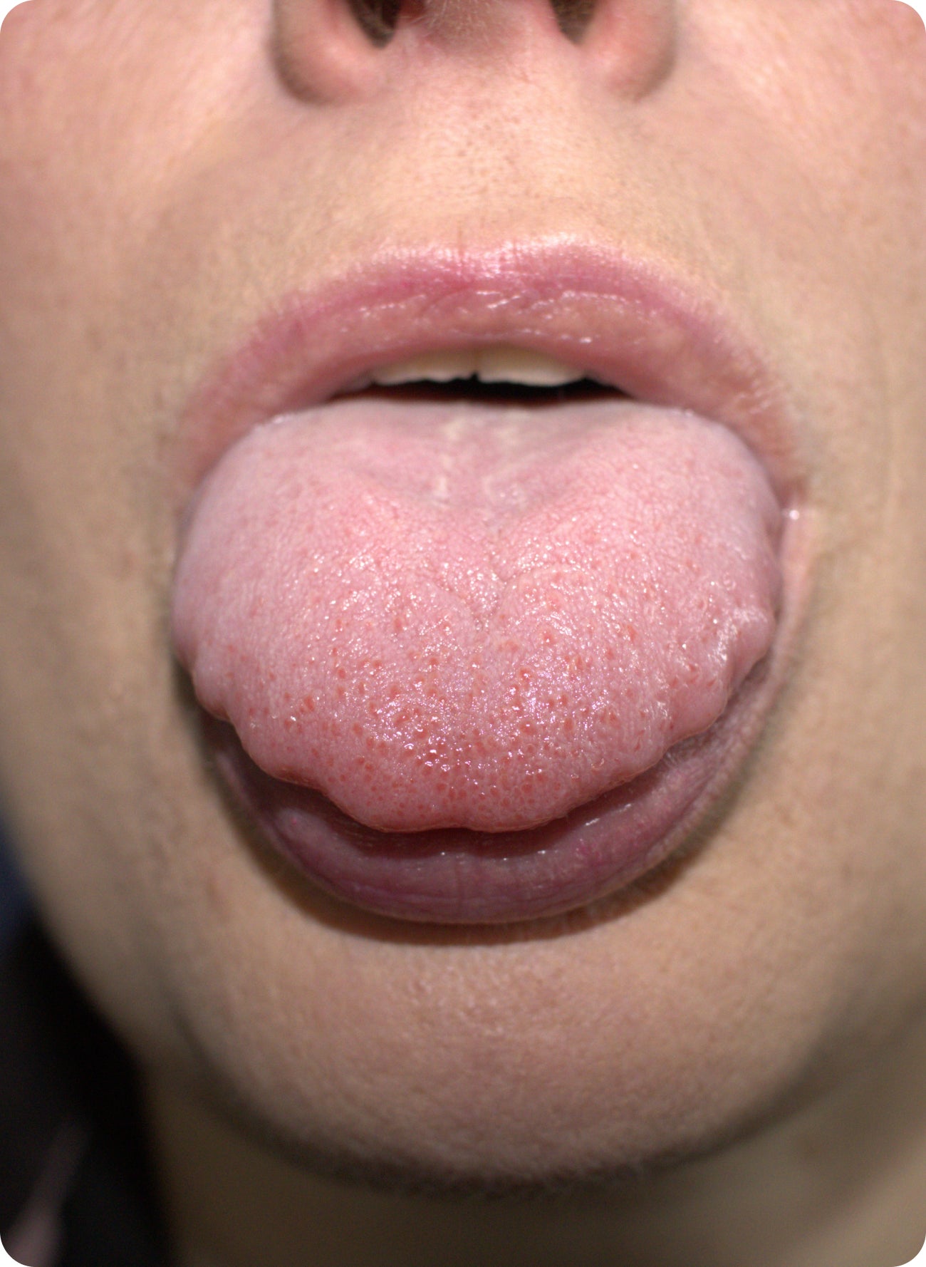 Close-up of a person sticking out their tongue, showing scalloped edges along the sides.