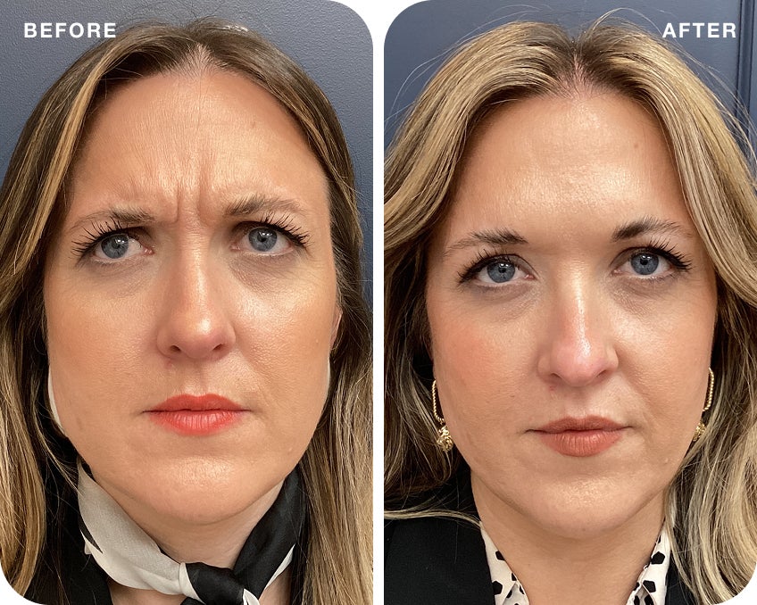 Side by side before and after images of a woman demonstrating the smoothing of frown lines and forehead wrinkles after Botox treatment