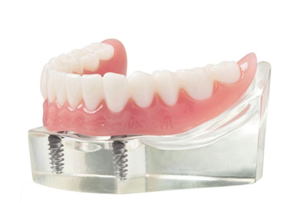 A model showing the structure of an implant denture, and how it's secured through two implants.