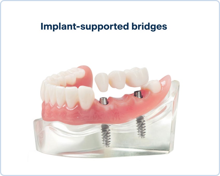An image of a lower arch teeth model with an implant-supported bridge, anchored by two titanium implants on neighboring teeth.