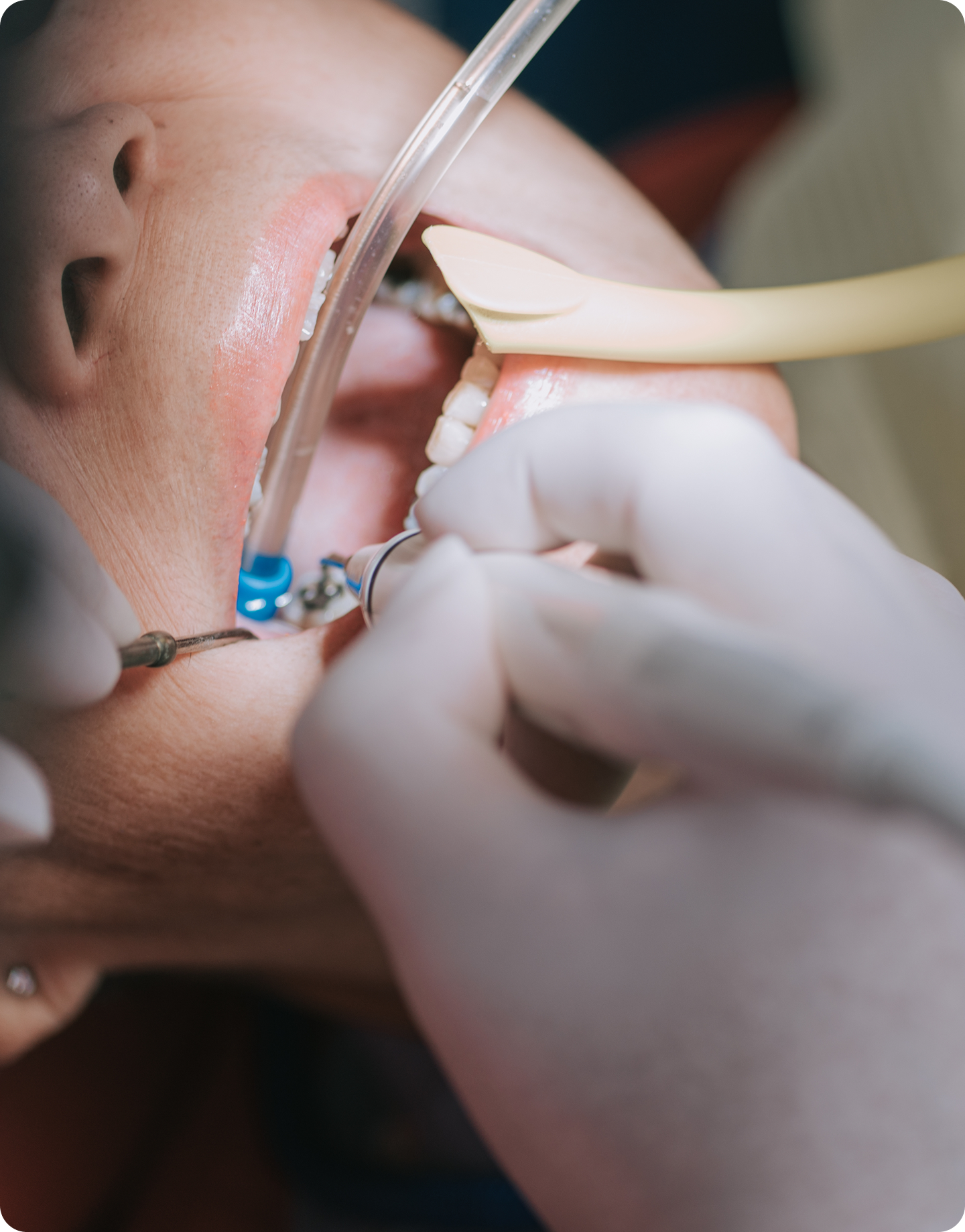 Root canal infections: Symptoms and causes