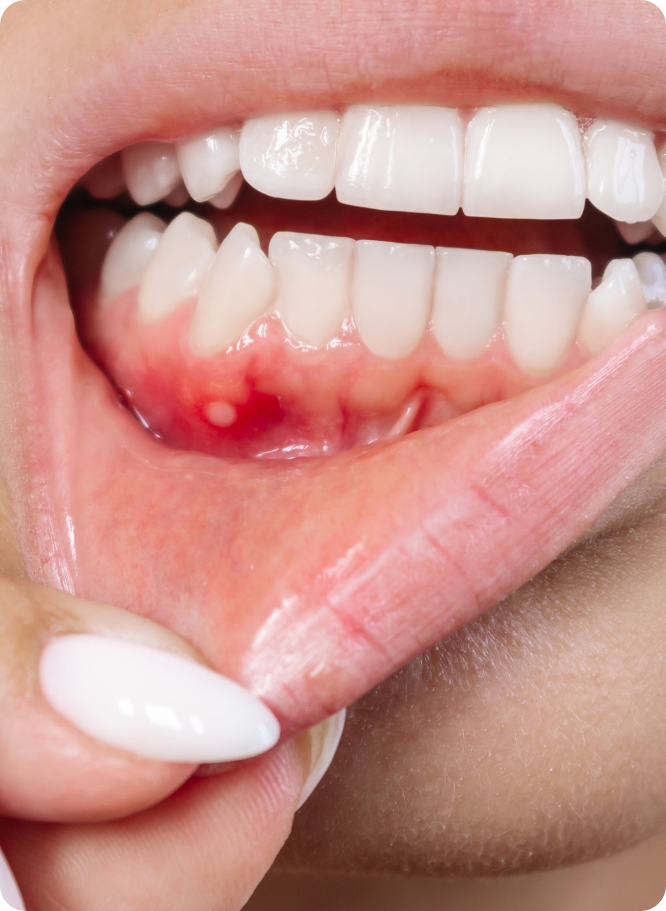 Close-up of a gum bump near the lower teeth, suggesting concern about whether it is a gum pimple or an abscess.