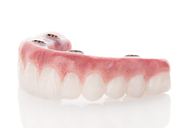 A model showing the structure of a fixed full arch dental implant and how it's secured through four implants.