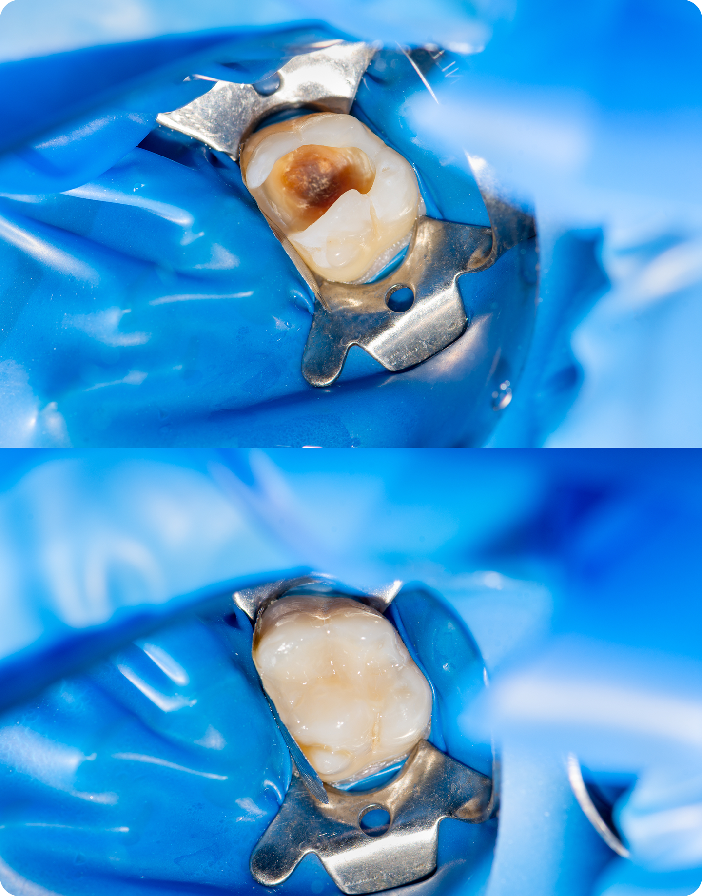 Root canals: before and after