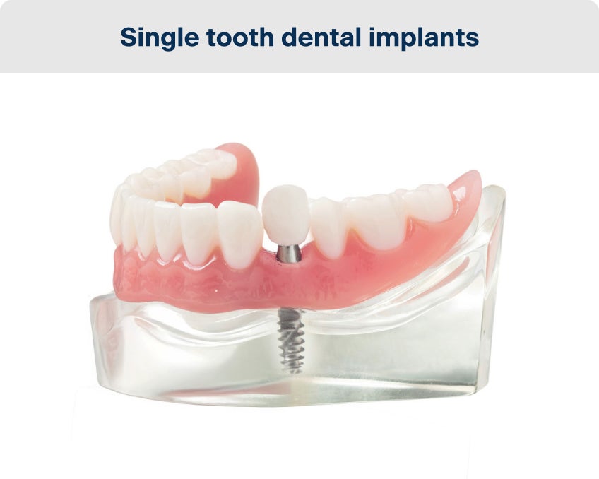 Model of a single tooth dental implant showing an implant post supporting a single artificial tooth within a clear acrylic jaw base.