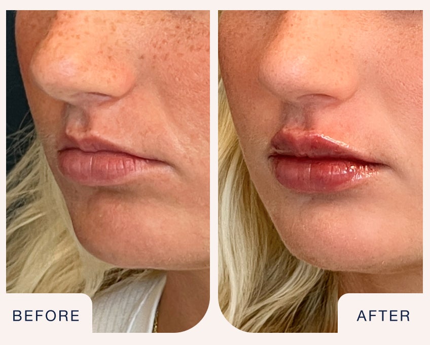  Lip filler before and after highlighting fuller, more defined lips with added volume and hydration at Chapter.
