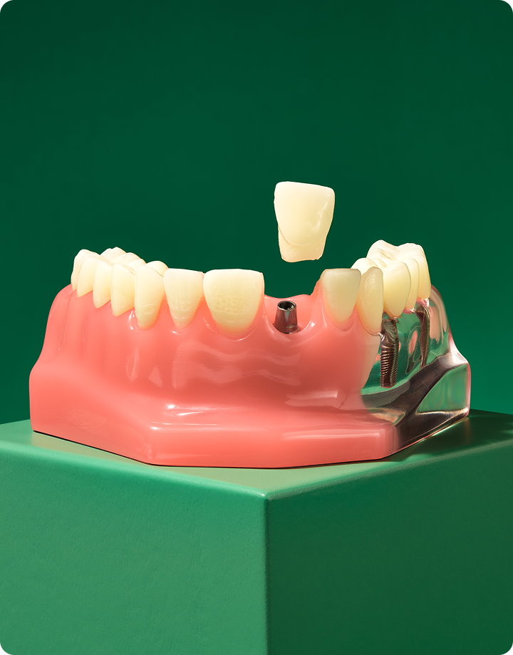 Dental model demonstrating an implant, crown, and bridge