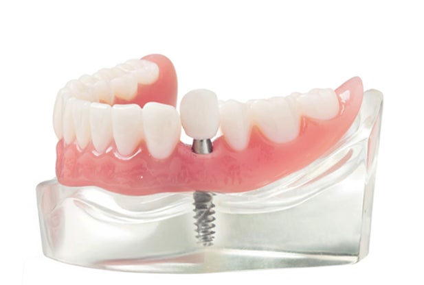 A model showing the structure of an implant supported bridge, and how it's secured through two neighboring implants.
