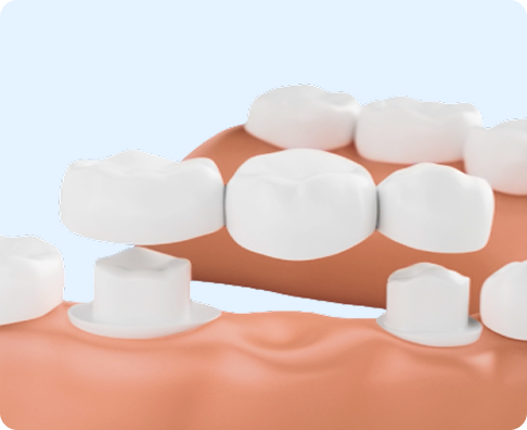 A dental bridge is shown being placed over two prepared teeth.