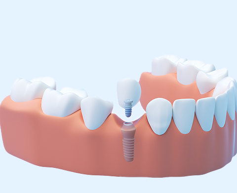 A dental implant procedure is illustrated with a lower jaw showing a missing tooth. A screw is inserted into the jawbone, and an abutment and crown are positioned above it.