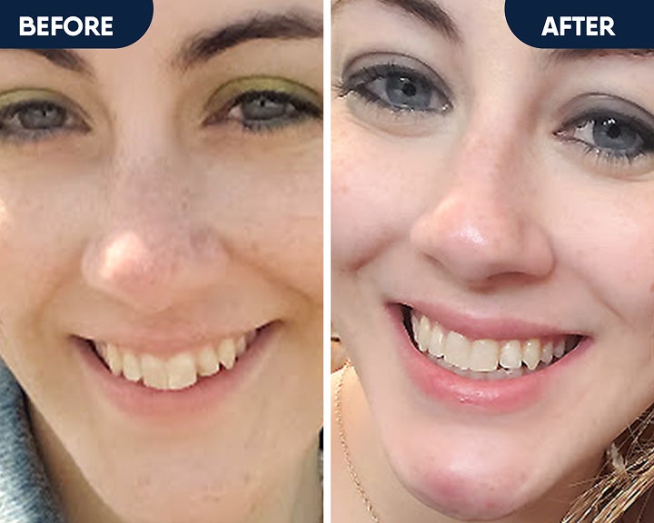 Before and after smile showing improved teeth alignment and oral health results from affordable clear aligner treatment with Motto