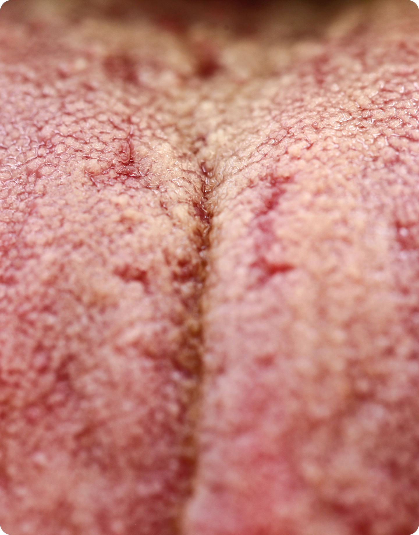 Oral thrush (candidiasis)