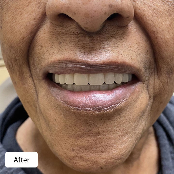 Patient's smile after receiving full arch dentures